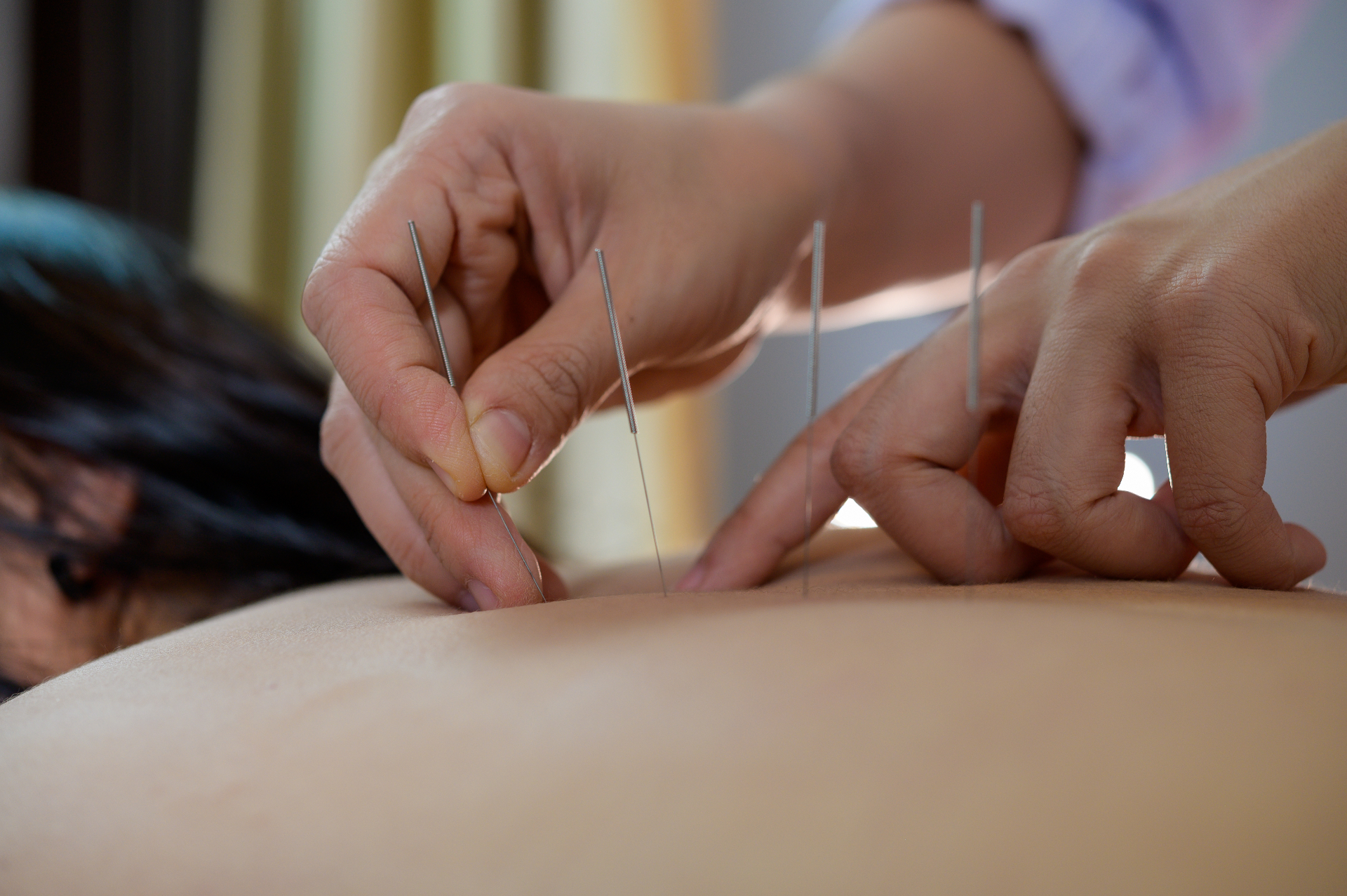 Acupuncture & Dry Needling